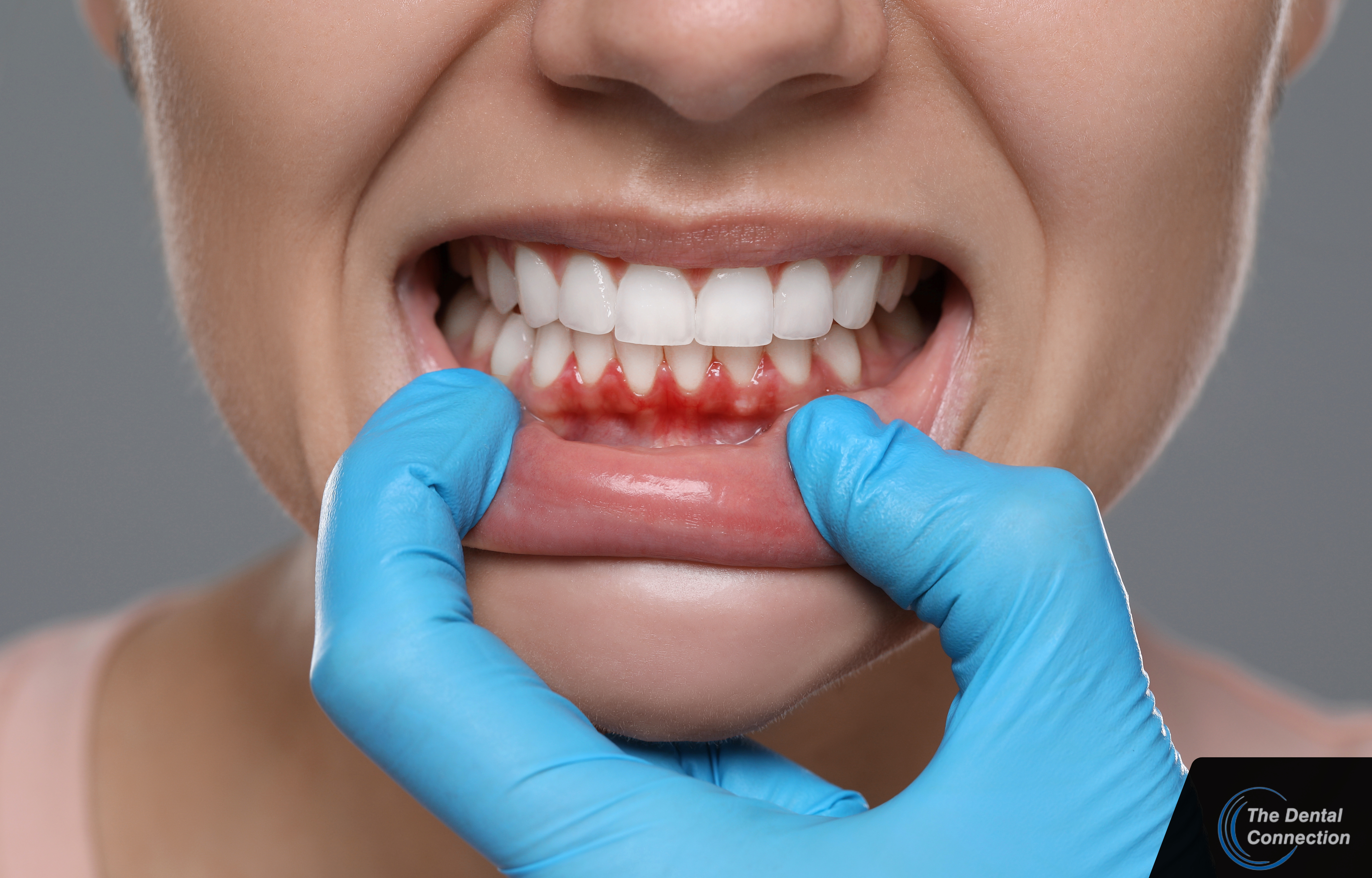 What is Gum Disease & How to Get Rid of It – Advice from a Surbiton Dentist