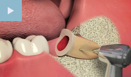 Extractions