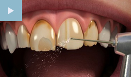 Veneers
