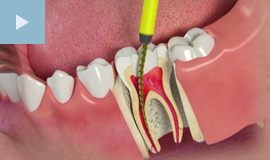 Root Canal Treatment