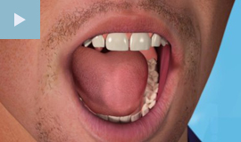 White Fillings